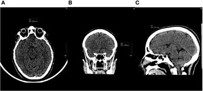 Case report: complete long-lasting response to multimodal third line treatment with neurosurgical resection, carmustine wafer implantation and dabrafenib plus trametinib in a BRAFV600E mutated high-grade glioma